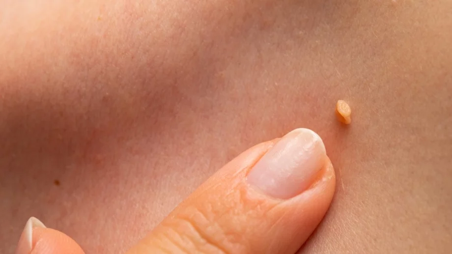 5 прости и ефективни начина да държите брадавиците надалеч