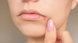 3 натурални метода да третирате херпес на устата