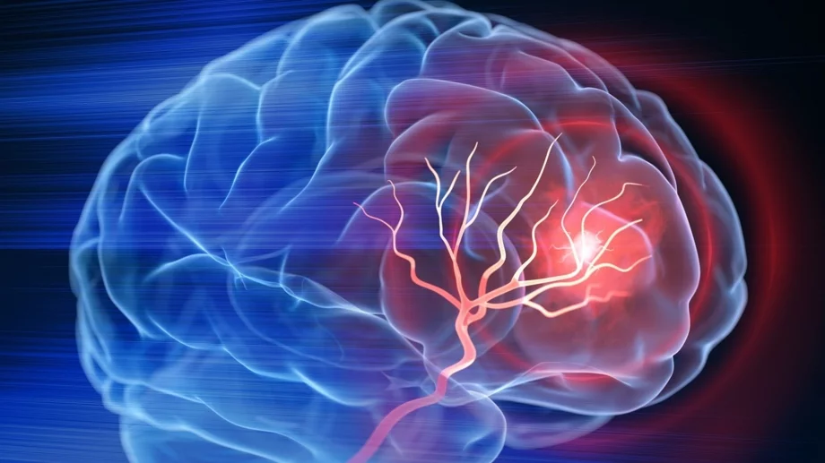 Внимавайте: Тези храни увеличават риска от инсулт 