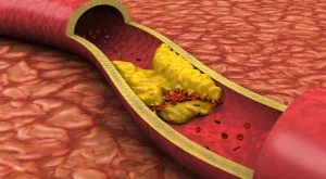 Как да предотвратите запушването на артериите
