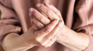 Разбиваме 5-те мита за екземата