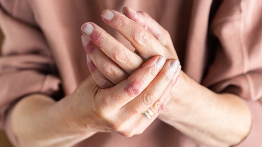 Разбиваме 5-те мита за екземата