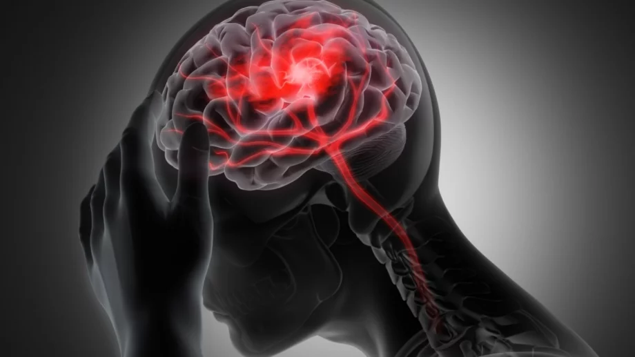  3 рискови фактора, които могат да доведат до инсулт  