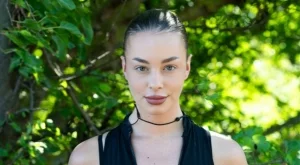 Цената на красотата: Пелипенко с алергия след поставяне на евтин филър