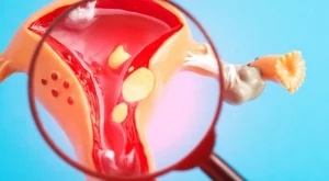 Миома на матката: Симптоми и рискове