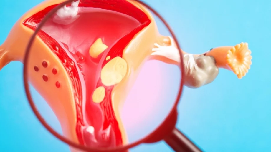 Миома на матката: Симптоми и рискове