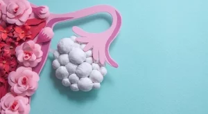 5 начина да се отървете от излишните килограми, ако имате поликистозни яйчници