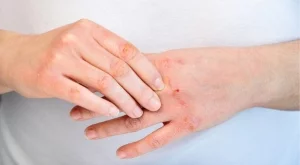 Как бързо да успокоите симптомите на студова алергия с натурални средства