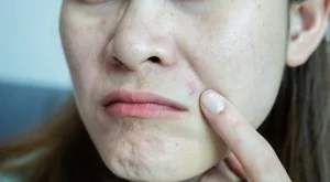 Какво представляват себумните тапи и как да се отървете от тях?