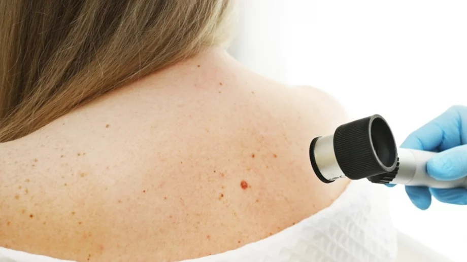 6 ранни признака на меланом, които сме склонни да игнорираме