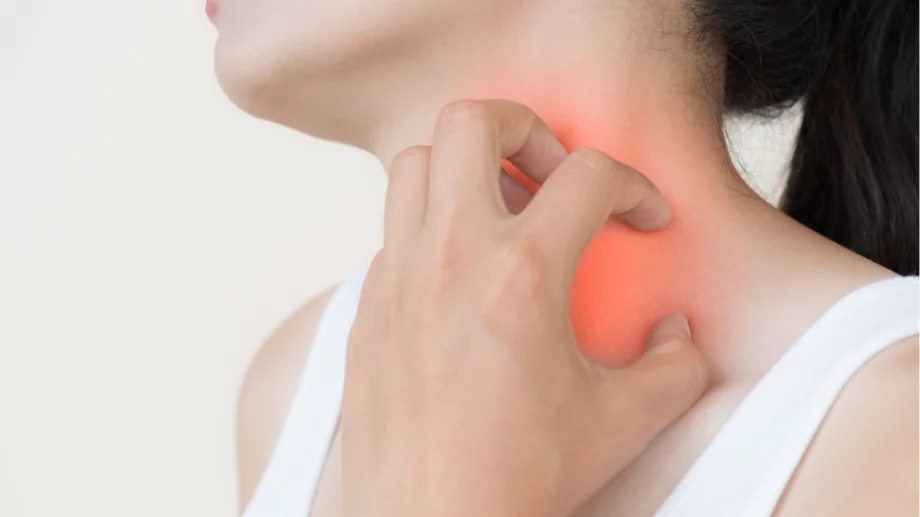 Изключете тези храни и напитки от диетата си и ще забравите за уртикарията 