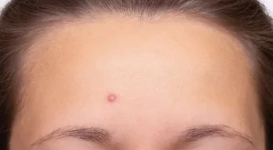 5 кожни пъпки, които не са акне и може би пренебрегвате