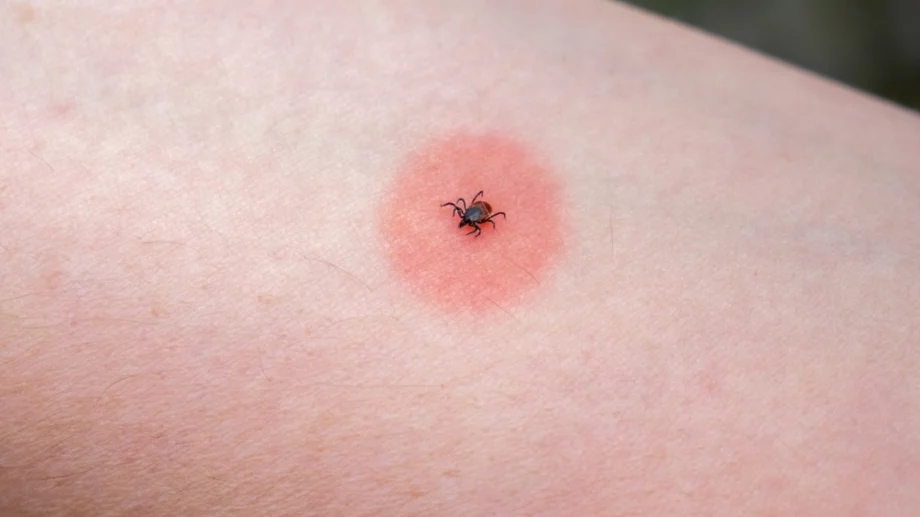 6 тревожни знака, че е възможно да сте били ухапани от кърлеж