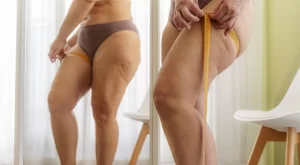 6 симптома на липедемата, често бъркана със затлъстяване