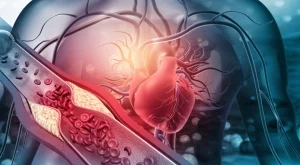 Здраве на сърцето: 4 начина да проверите за артериална плака у дома