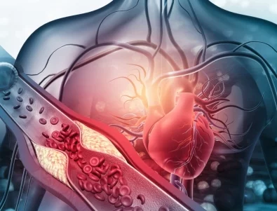 Здраве на сърцето: 4 начина да проверите за артериална плака у дома