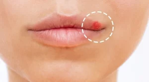Как бързо да се отървете от херпес? Ефективни домашни решения, които помагат