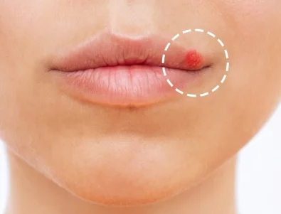 Как бързо да се отървете от херпес? Ефективни домашни решения, които помагат