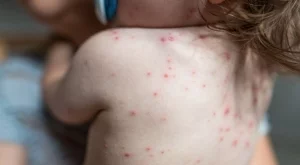 Завишени случаи на морбили у нас: Какво трябва да знаем