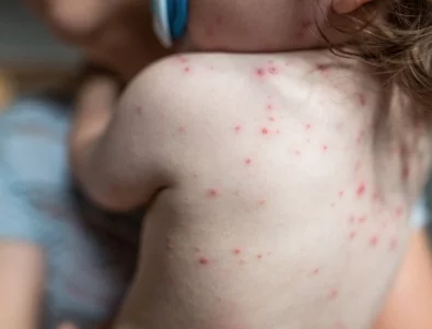 Завишени случаи на морбили у нас: Какво трябва да знаем