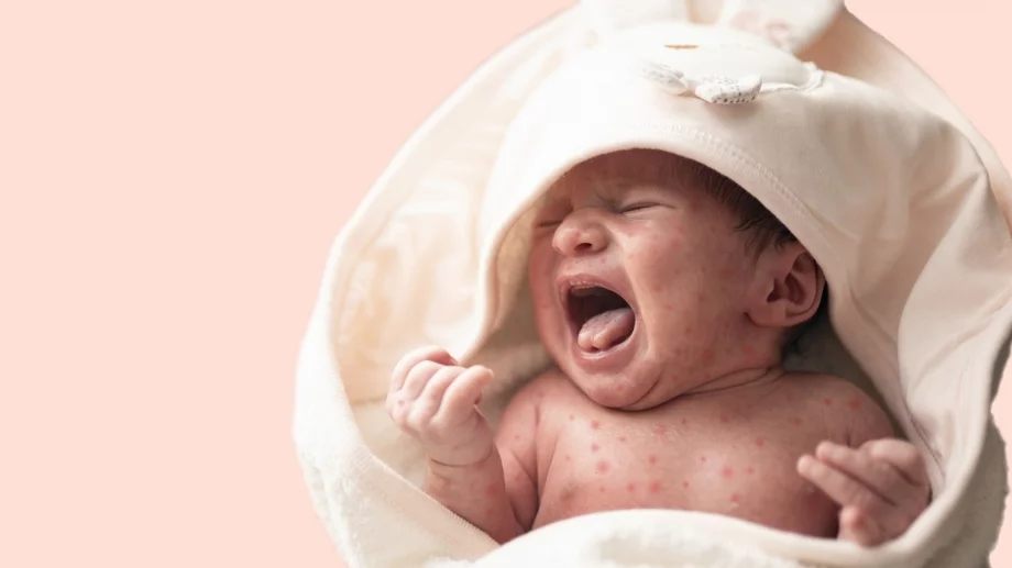 На фона на растящи случаи на морбили у нас: Тече антиваксърска кампания